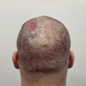 crown head hair transplant