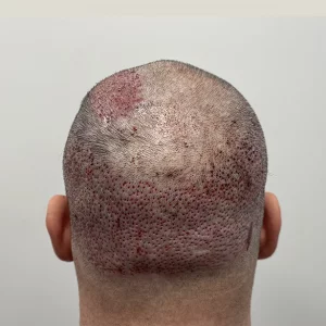 crown head hair transplant