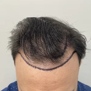 man hair loss