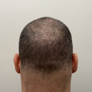 head crown