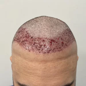 hair transplant